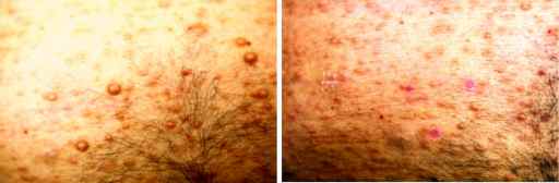 Figuras 3-A y 3-B. Neurofibromas . A. Pretratamiento con lser de Er:YAG , B. Postratamiento (al mes)
