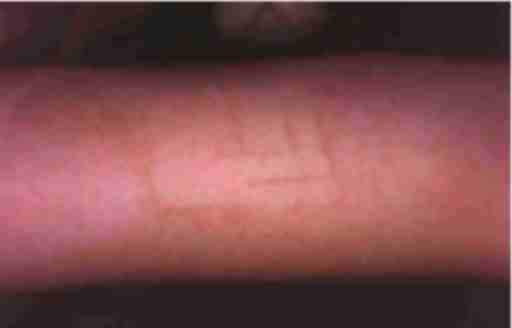 Figura 1. Mancha café con leche : parte central tratada con IPL (1 mes postratamiento ); se observa area no tratada entre los impactos de la emisión de luz no coherente. En la parte derecha se ha tratado con láser Nd-YAG desdoblado 532 nm Q-S en las mismas fechas.