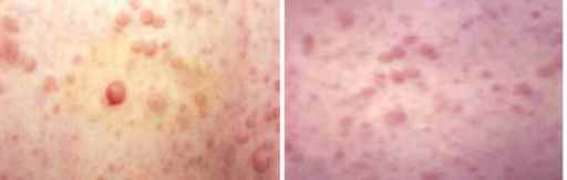 Figura 2-A y 2-B. Neurofibromas . A. Pretratamiento con láser de Er:YAG , B. Postratamiento (a los 5 meses)